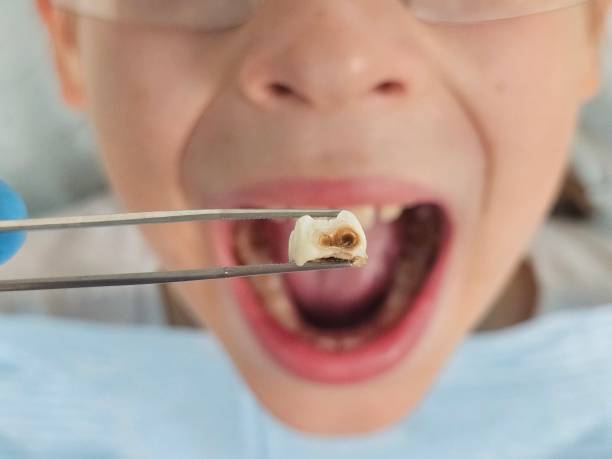 Best Emergency Tooth Extraction in Walton Hills, OH
